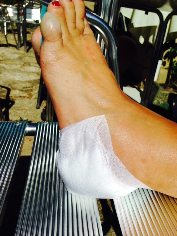 Kerstin's foot after treatment
