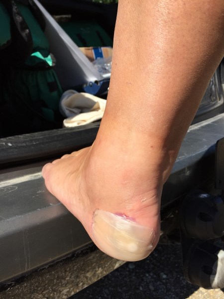 Kerstin's foot before treatment